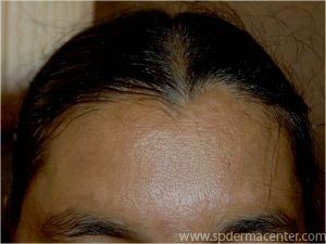 Melasma-Before